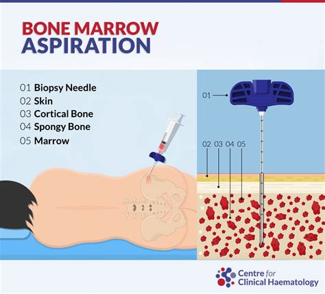 bone marrow aspiration procedure steps.